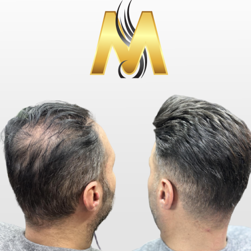 پروتز مو نیوزلندی